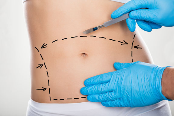 Abdominoplastik Dresden